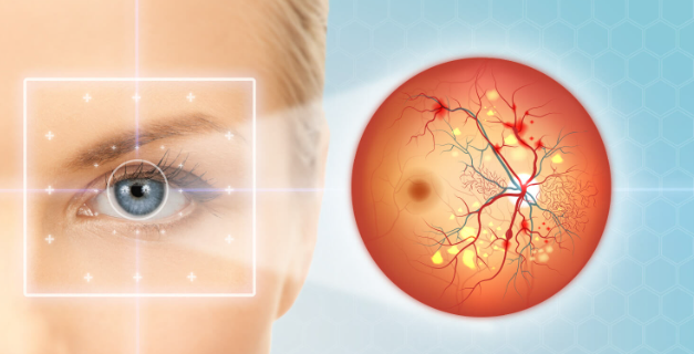 Diabetic Retinopathy