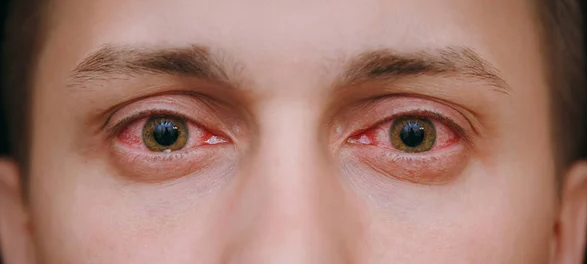 Conjunctivitis 